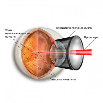 Лазерная коагуляция сетчатки глаза цена воронеж